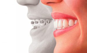 Invisalign available at Newman Family Dentistry in Indianapolis Indiana